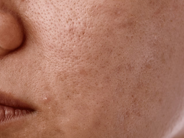 HyperPigmentation panchtattvashop