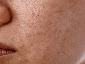 HyperPigmentation panchtattvashop